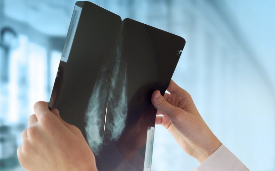 Le cancer du sein controlatéral: définition, facteurs de risque et traitements
