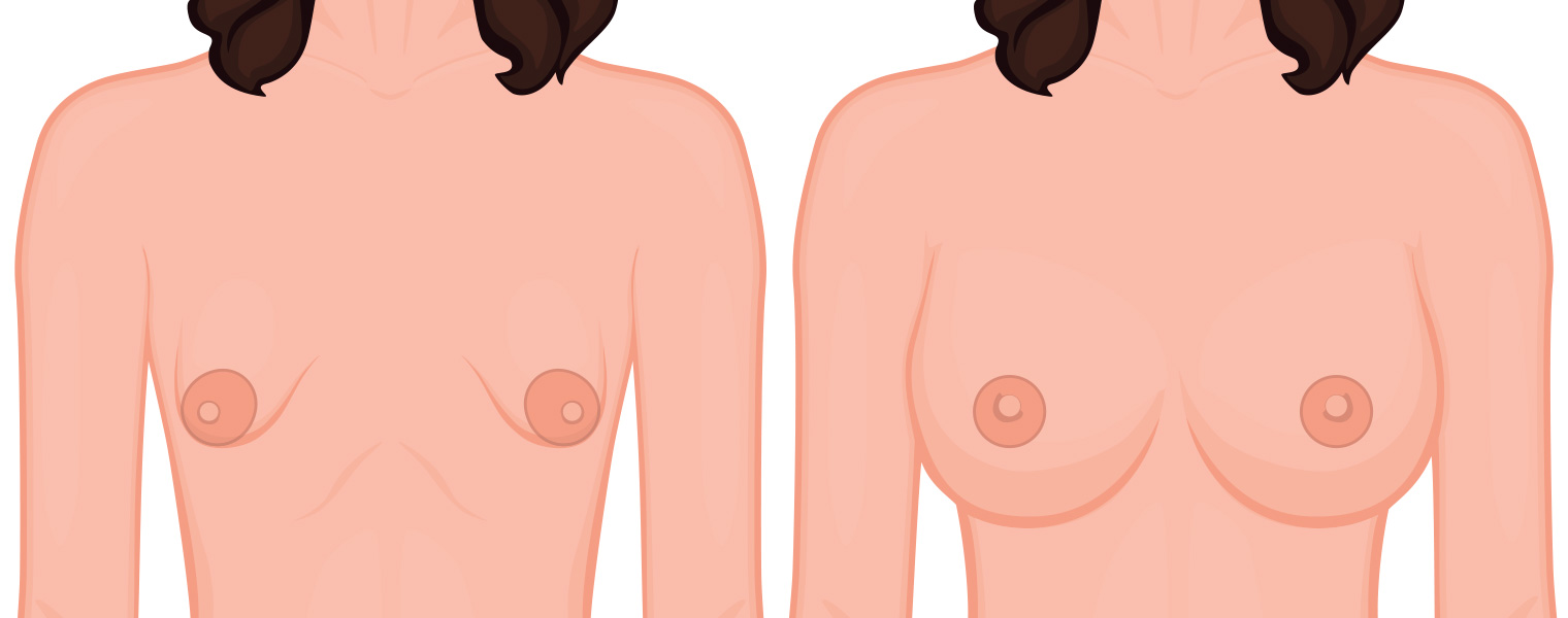 Seins tubéreux, la chirurgie peut-elle aider?