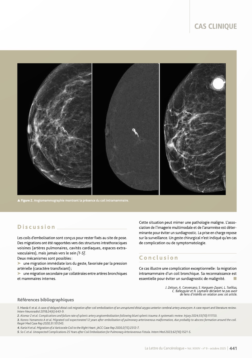 Migration intramammaire d’un coil bronchique - Page n1
