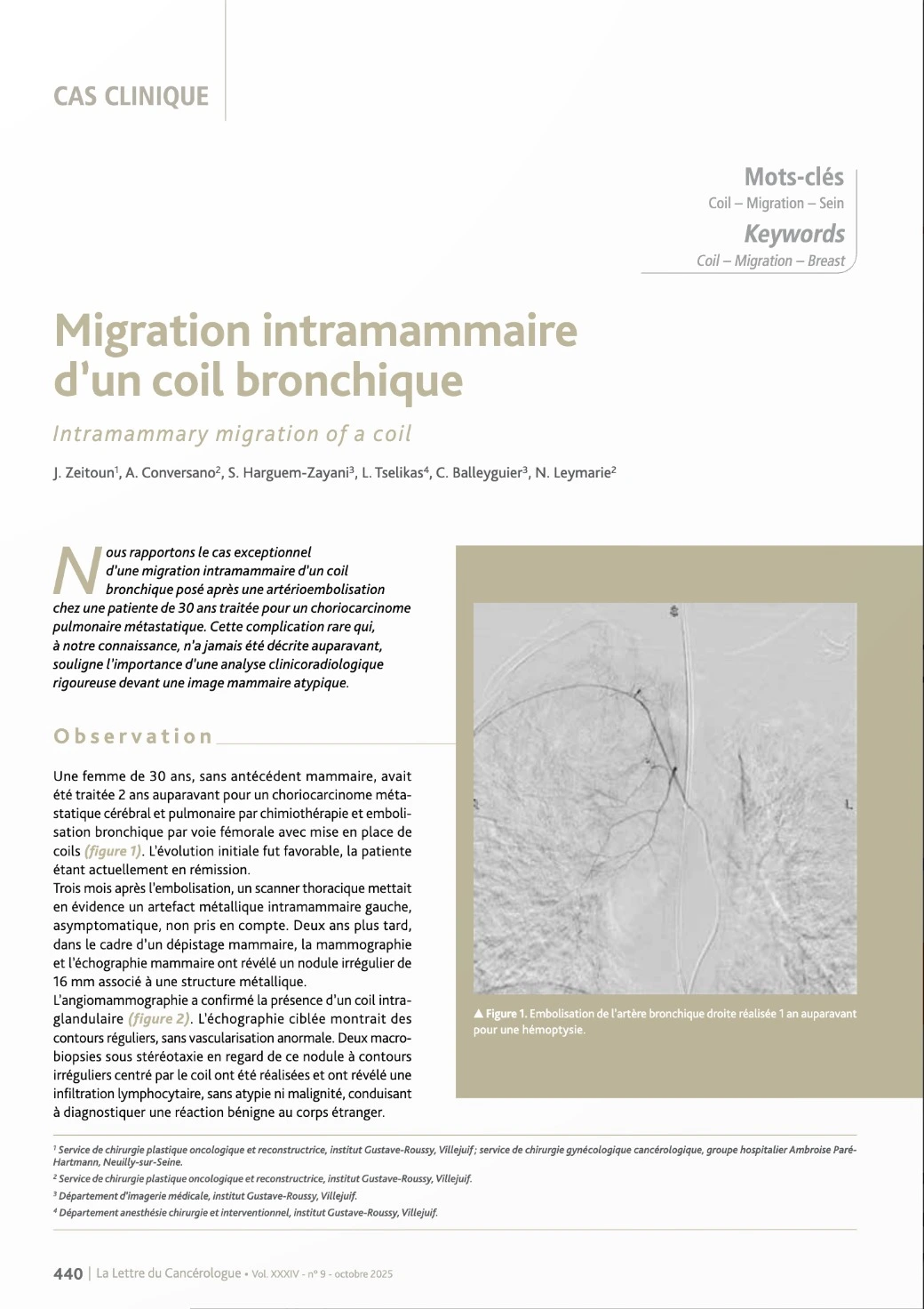 Migration intramammaire d’un coil bronchique - Page n1