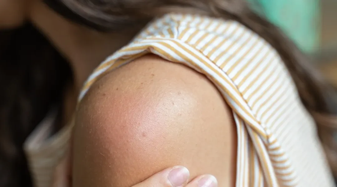 Le lymphœdème ou « gros bras » après un traitement du cancer du sein